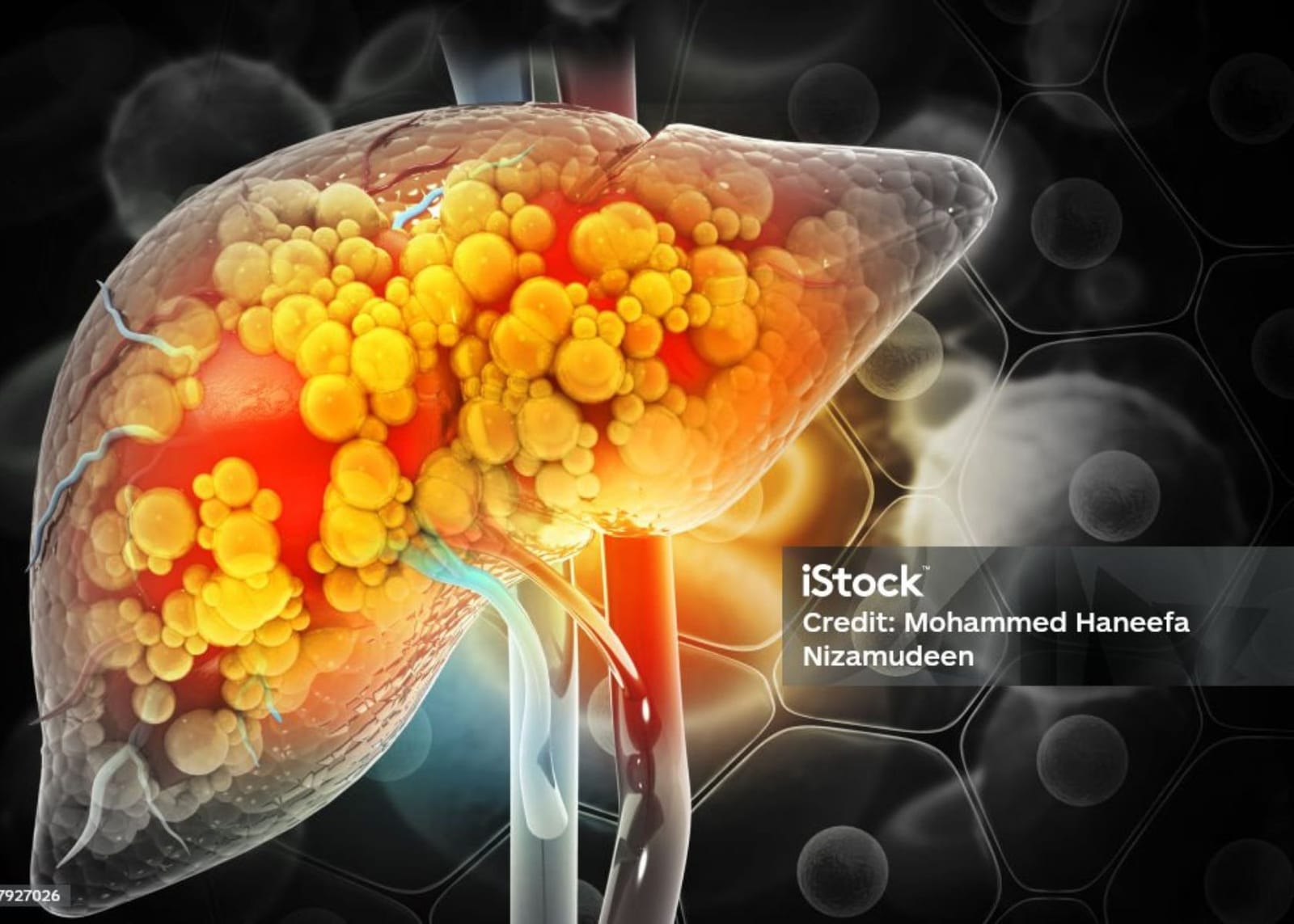 Liver Cirrhosis liver-cirrhosis